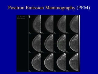 Pem Scan Radiological approach for malignant breast lesions | PPTX
