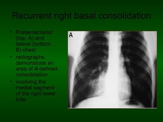 Radiological approach to a child with chest infection | PPT