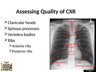 Radiological_diagnosis_of_TB_ECHO_MOH[1].pptx