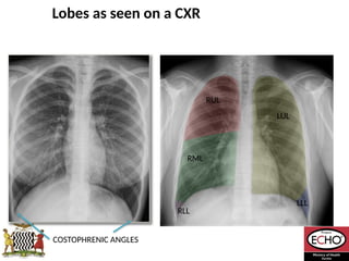 Radiological_diagnosis_of_TB_ECHO_MOH[1].pptx