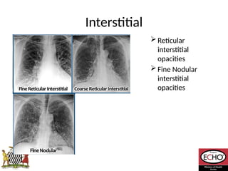 Radiological_diagnosis_of_TB_ECHO_MOH[1].pptx