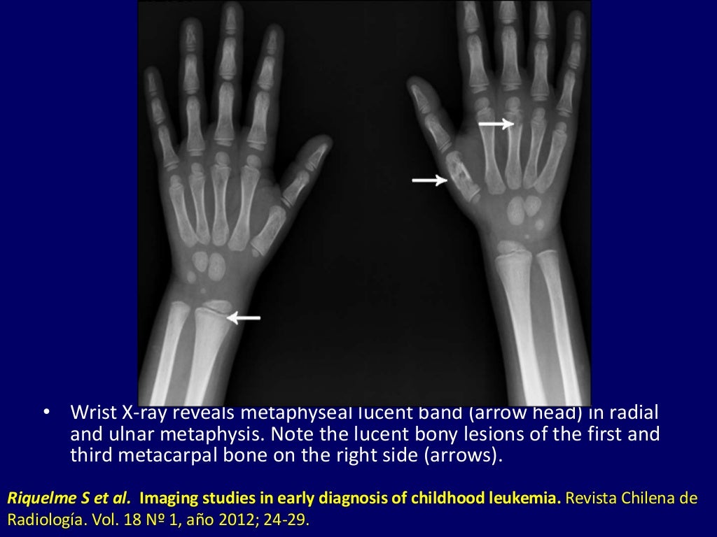Radiological approach to leukemia