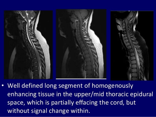 Radiological Approach To Leukemia