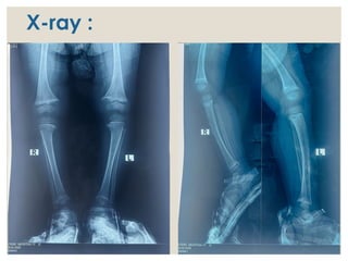 Radiological evaluation of RICKETS .pptx