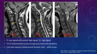 Pancake Sign Radiopedia Radiological evaluation of spinal tumours | PPTX