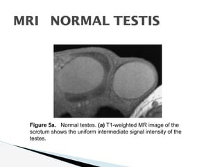 Mri Testes Radiological Evaluation of the Endocrine Glands(0).ppt.pdf