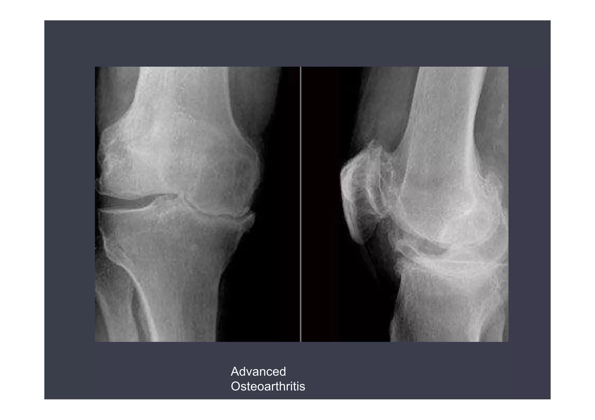 Radiological evaluation of TKR by Dr. D. P. Swami | PPTX