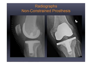 Radiological evaluation of TKR by Dr. D. P. Swami | PPTX