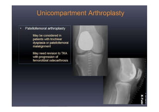 Radiological evaluation of TKR by Dr. D. P. Swami | PPTX