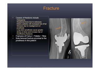 Radiological evaluation of TKR by Dr. D. P. Swami | PPTX