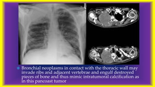 Radiological features of Lung cancer Dr. Muhammad Bin Zulfiqar | PPTX