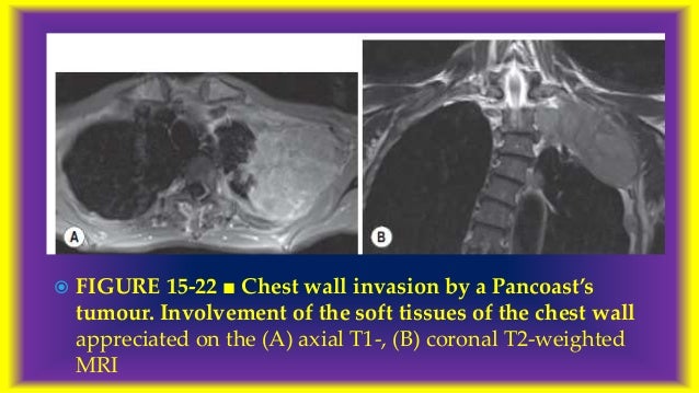 Radiological features of Lung cancer Dr. Muhammad Bin Zulfiqar