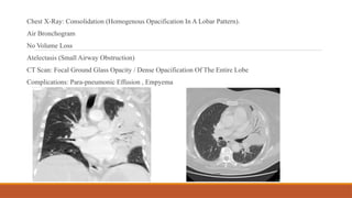Radiological findings in Pulmonary Infections | PPTX