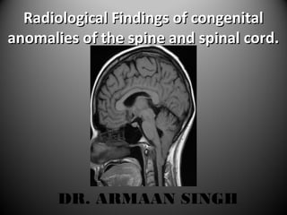 Radiological Findings of congenitalRadiological Findings of congenital
anomalies of the spine and spinal cord.anomalies of the spine and spinal cord.
DR. ARMAAN SINGH
 