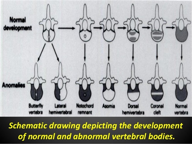 Radiological findings of congenital anomalies of the spine and spinal…