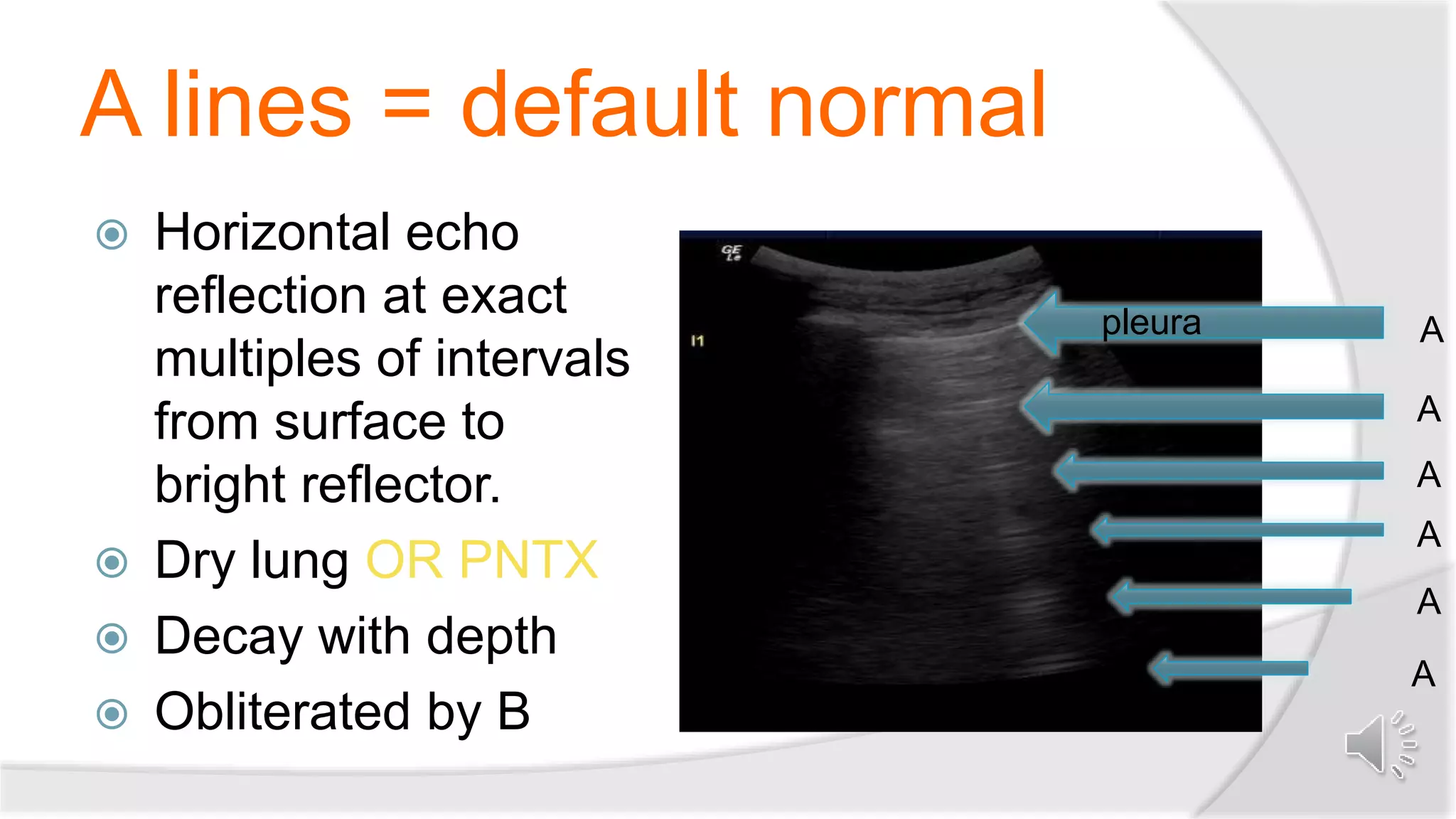 A lines = default normal
 Horizontal echo
reflection at exact
multiples of intervals
from surface to
bright reflector.
 Dry lung OR PNTX
 Decay with depth
 Obliterated by B
pleura A
A
A
A
A
A
 
