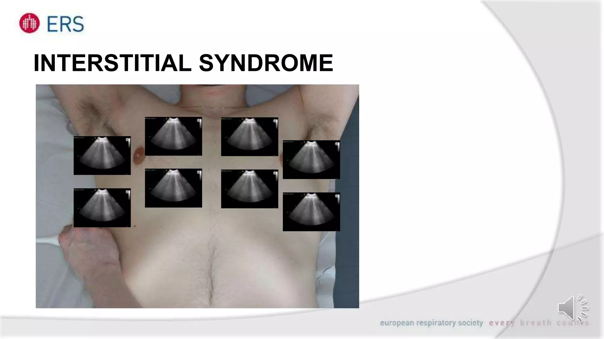 INTERSTITIAL SYNDROME
 