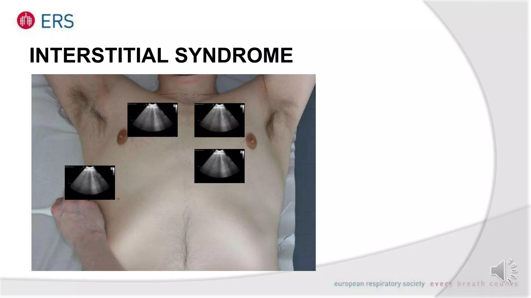 INTERSTITIAL SYNDROME
 