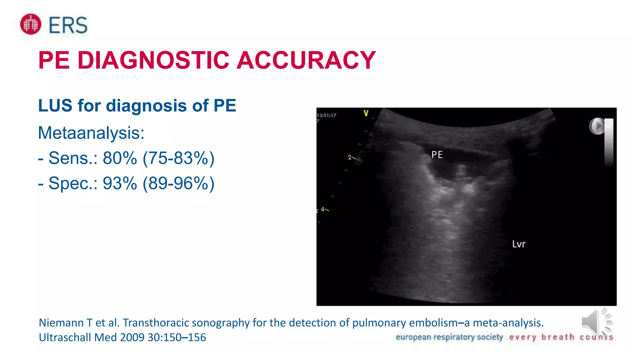 PE DIAGNOSTIC ACCURACY
LUS for diagnosis of PE
Metaanalysis:
- Sens.: 80% (75-83%)
- Spec.: 93% (89-96%)
Niemann T et al. Transthoracic sonography for the detection of pulmonary embolism–a meta-analysis.
Ultraschall Med 2009 30:150–156
 