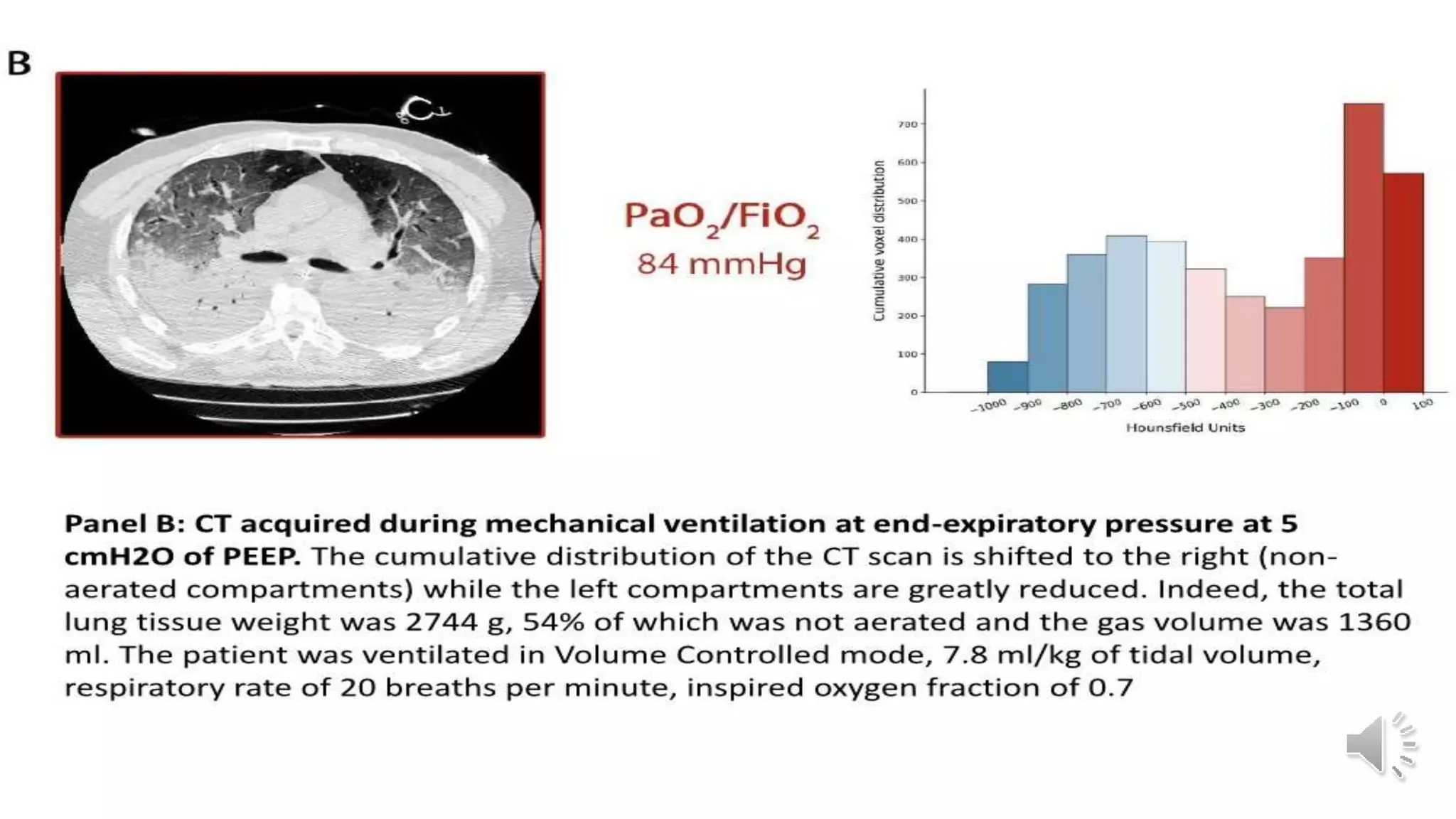 Radiological Presentation of COVID 19
