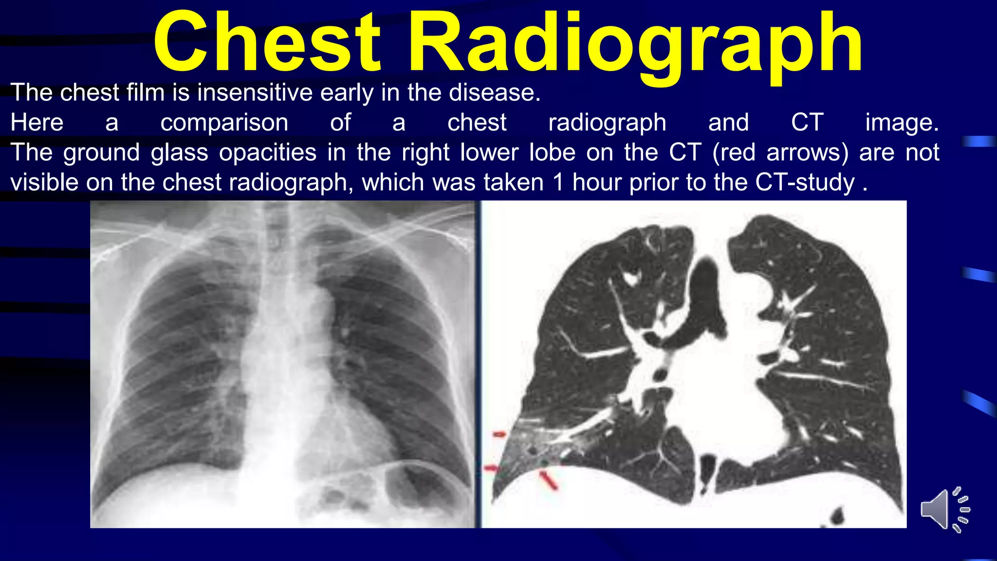 Chest RadiographThe chest film is insensitive early in the disease.
Here a comparison of a chest radiograph and CT image.
The ground glass opacities in the right lower lobe on the CT (red arrows) are not
visible on the chest radiograph, which was taken 1 hour prior to the CT-study .
 
