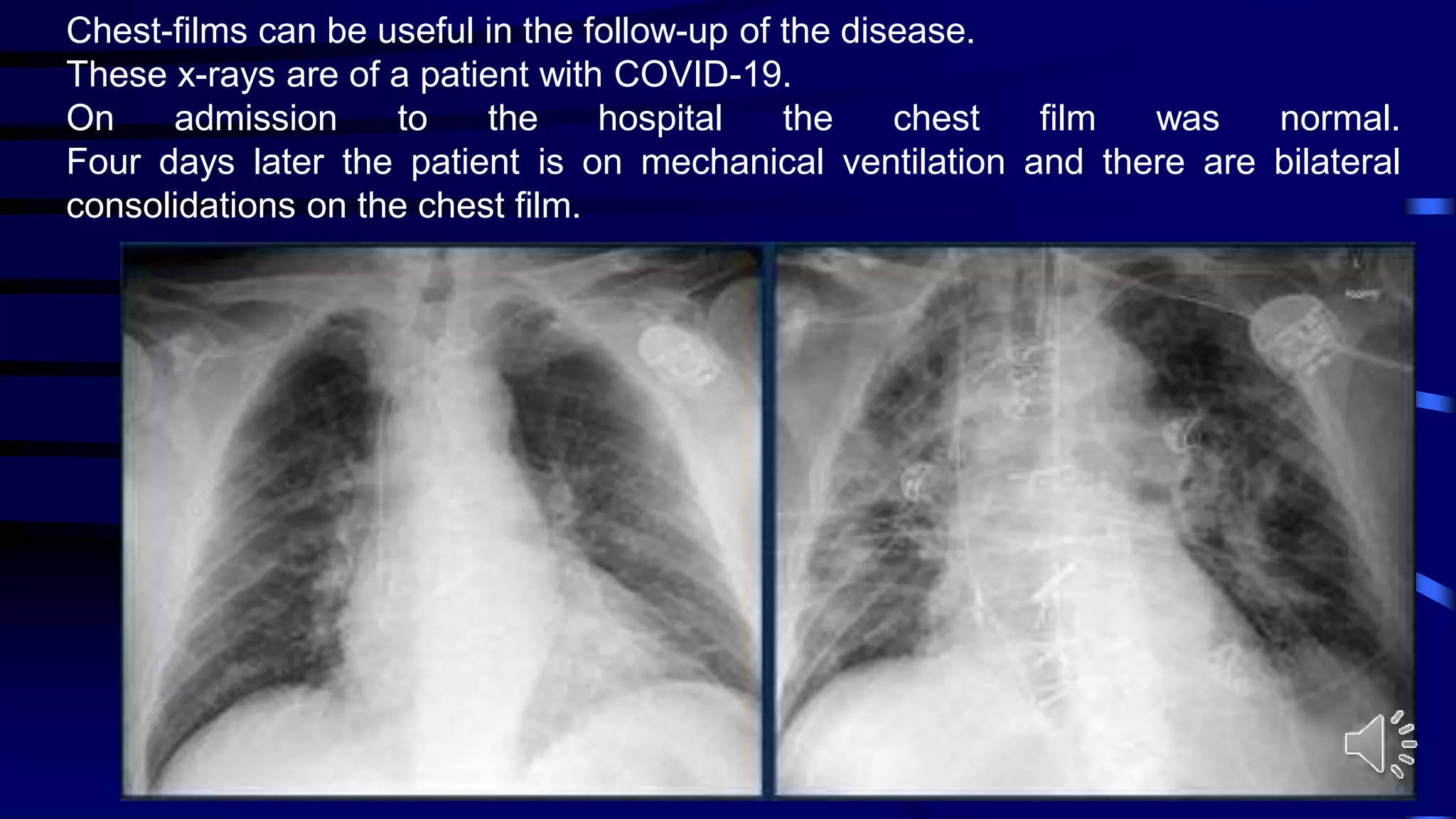Chest-films can be useful in the follow-up of the disease.
These x-rays are of a patient with COVID-19.
On admission to the hospital the chest film was normal.
Four days later the patient is on mechanical ventilation and there are bilateral
consolidations on the chest film.
 