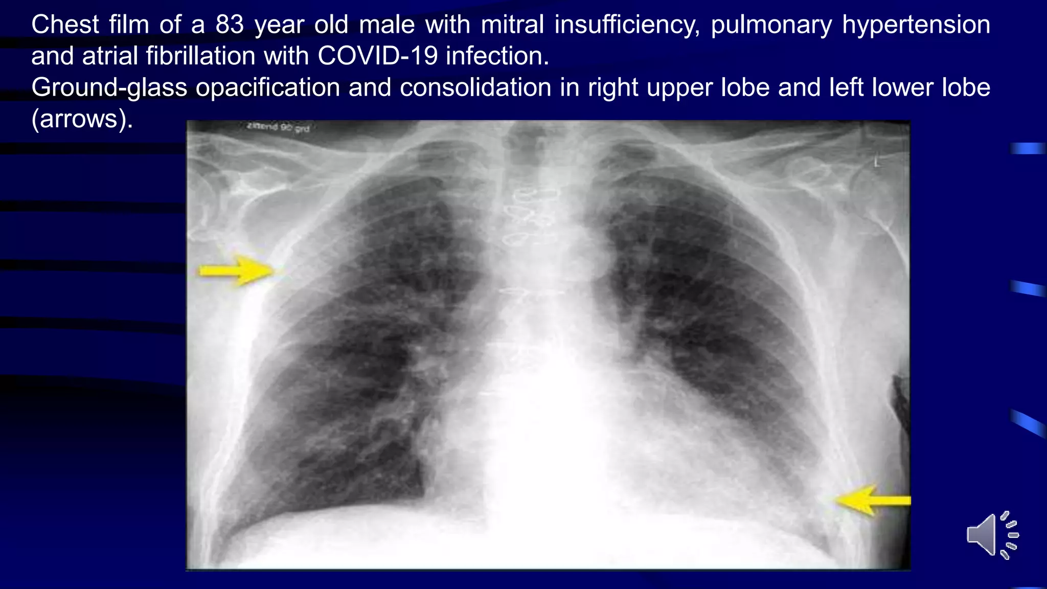 Chest film of a 83 year old male with mitral insufficiency, pulmonary hypertension
and atrial fibrillation with COVID-19 infection.
Ground-glass opacification and consolidation in right upper lobe and left lower lobe
(arrows).
 