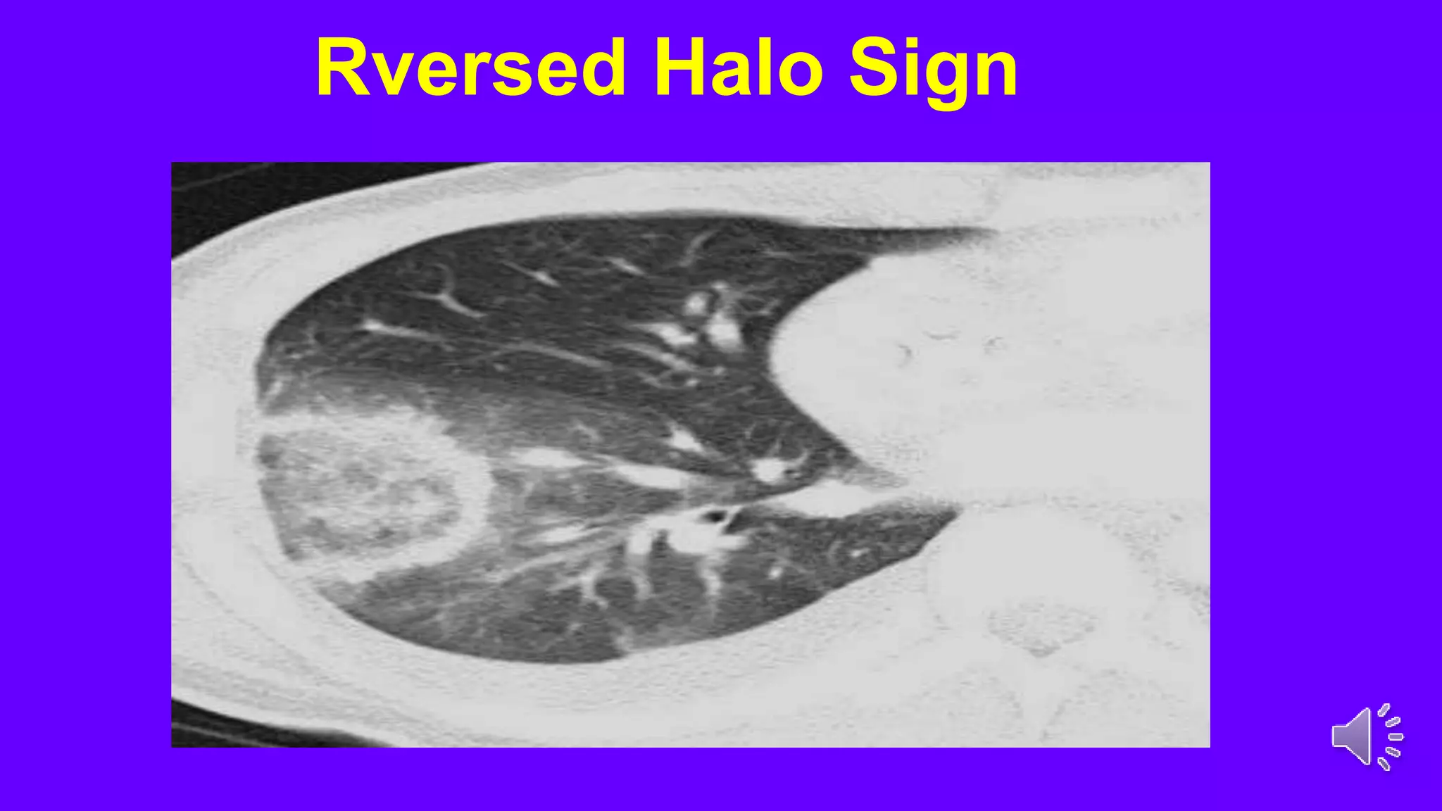 Rversed Halo Sign
 