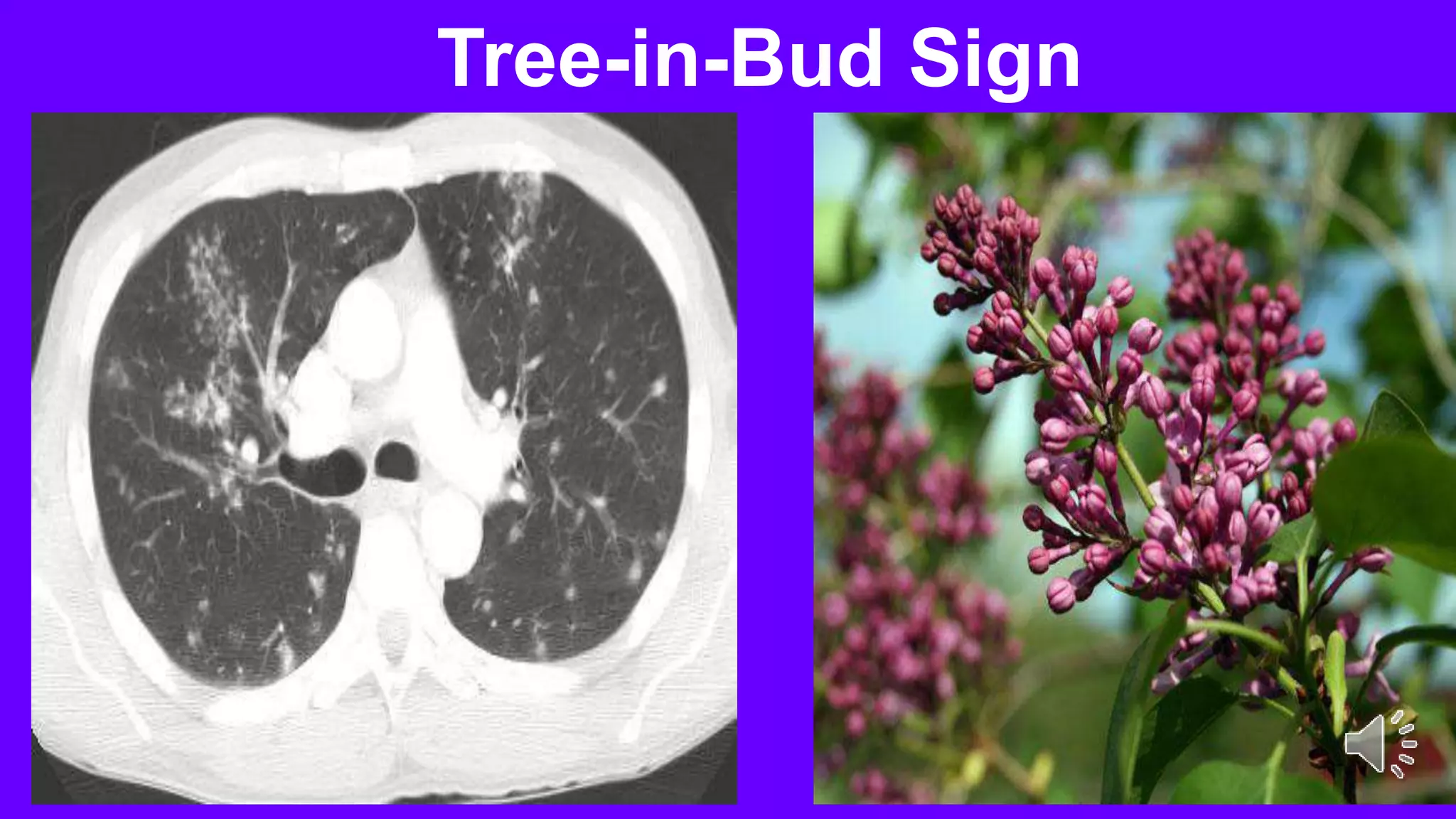 Tree-in-Bud Sign
 