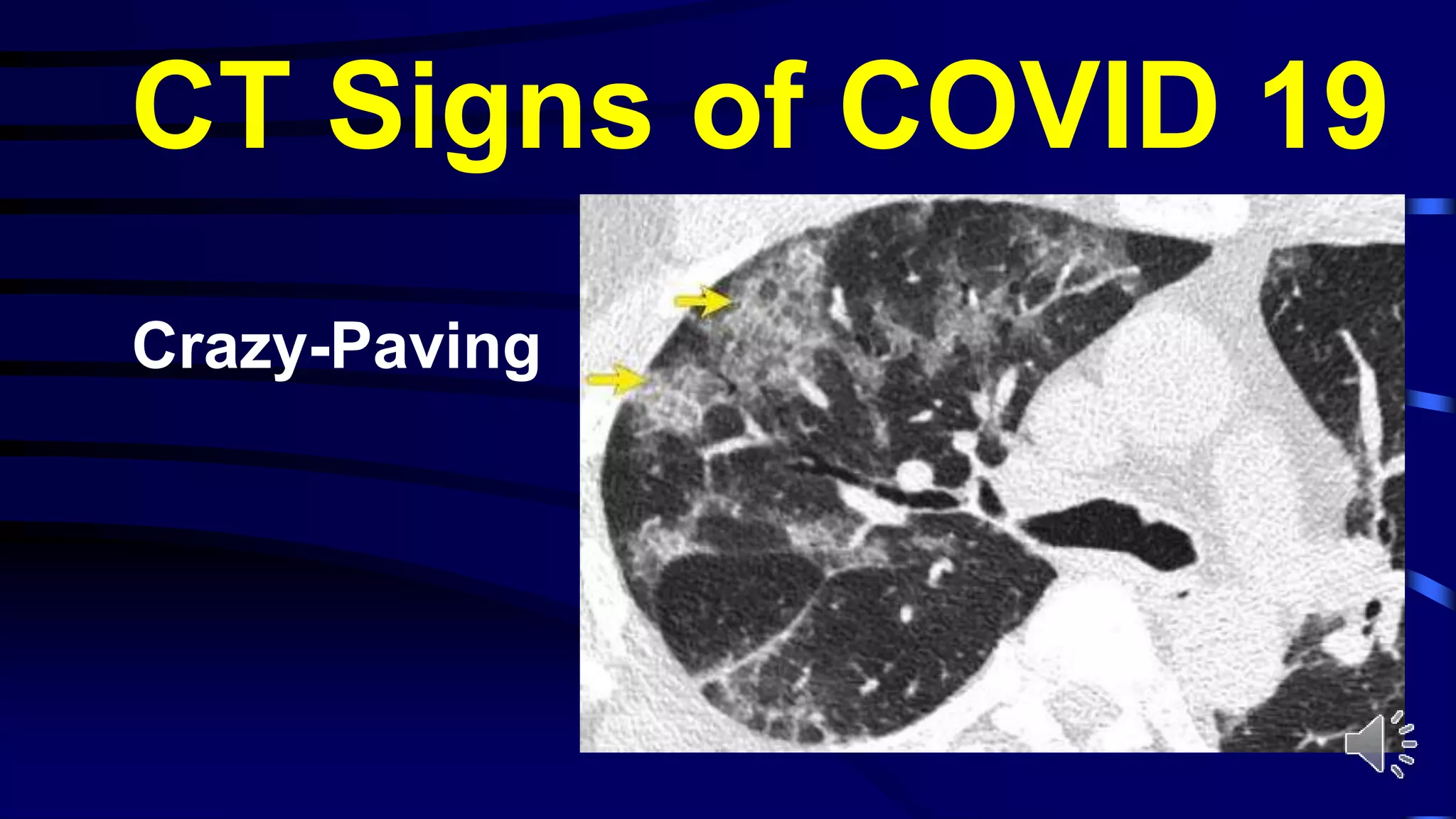 CT Signs of COVID 19
Crazy-Paving
 