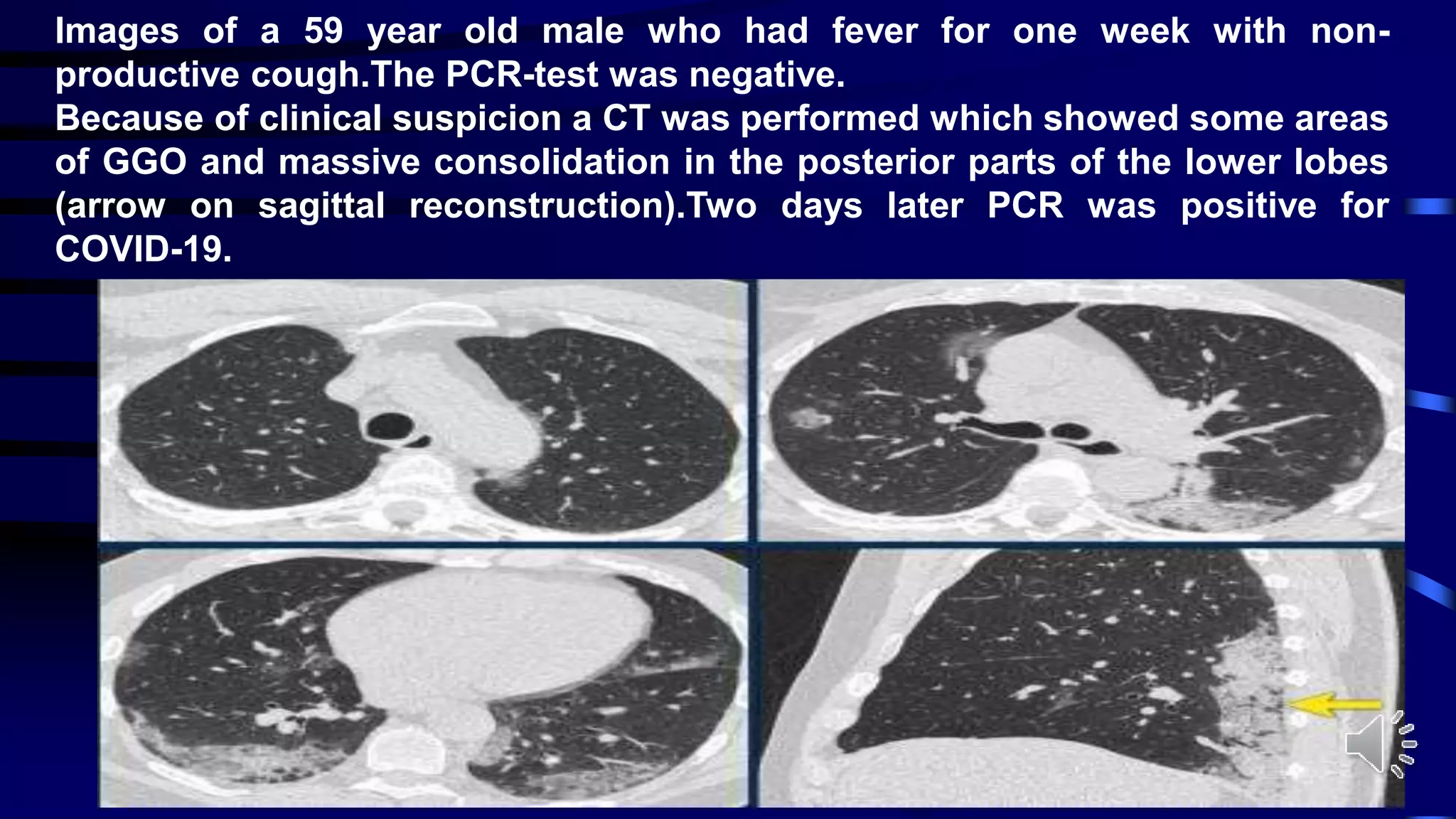 Images of a 59 year old male who had fever for one week with non-
productive cough.The PCR-test was negative.
Because of clinical suspicion a CT was performed which showed some areas
of GGO and massive consolidation in the posterior parts of the lower lobes
(arrow on sagittal reconstruction).Two days later PCR was positive for
COVID-19.
 