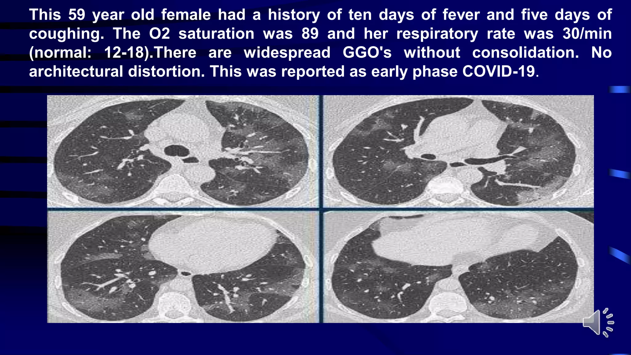 This 59 year old female had a history of ten days of fever and five days of
coughing. The O2 saturation was 89 and her respiratory rate was 30/min
(normal: 12-18).There are widespread GGO's without consolidation. No
architectural distortion. This was reported as early phase COVID-19.
 