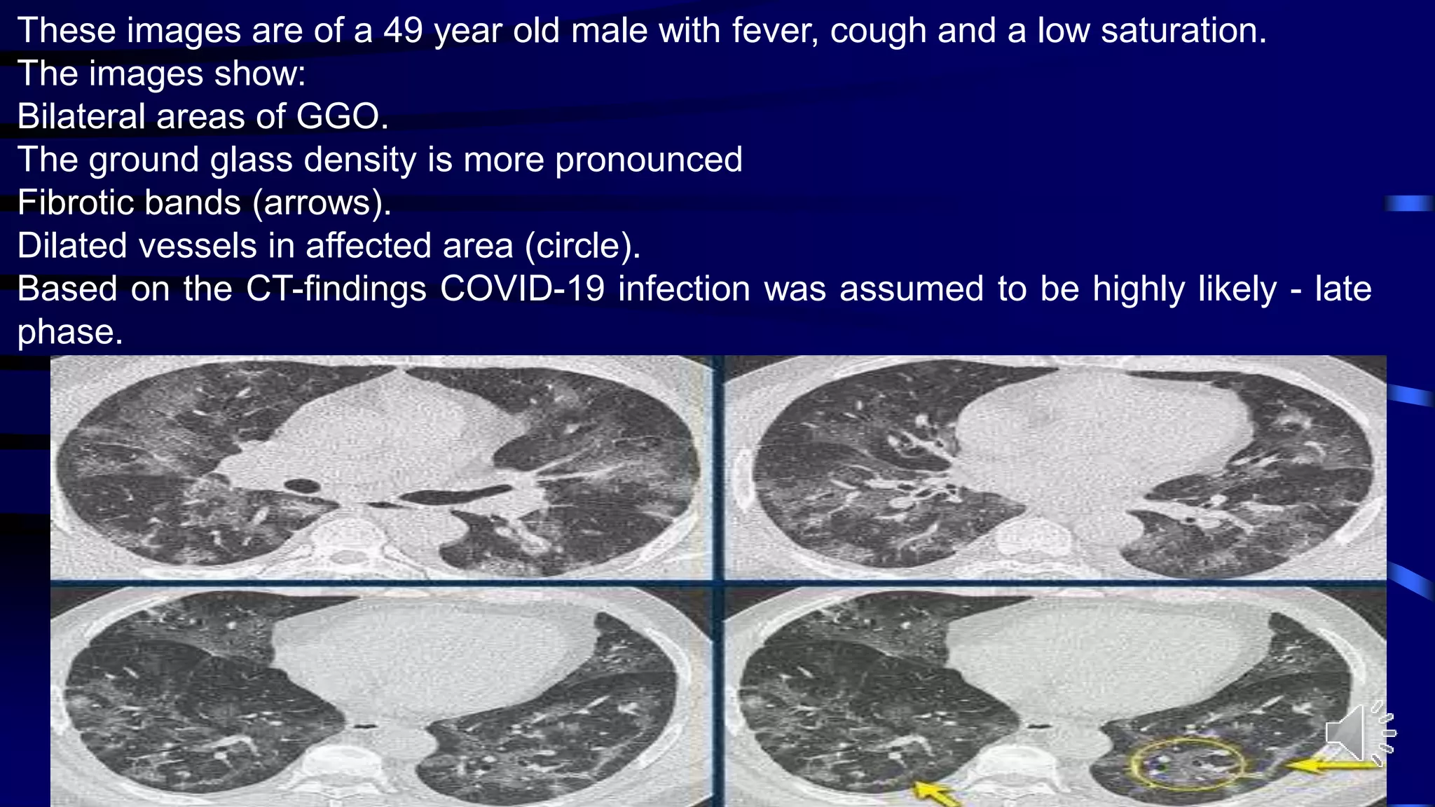 These images are of a 49 year old male with fever, cough and a low saturation.
The images show:
Bilateral areas of GGO.
The ground glass density is more pronounced
Fibrotic bands (arrows).
Dilated vessels in affected area (circle).
Based on the CT-findings COVID-19 infection was assumed to be highly likely - late
phase.
 