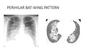 Radiological findings of pulmonary consolidation and collapse | PPTX