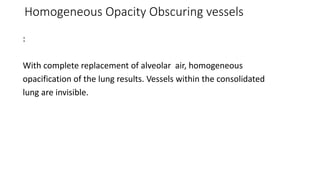 Radiological findings of pulmonary consolidation and collapse | PPTX