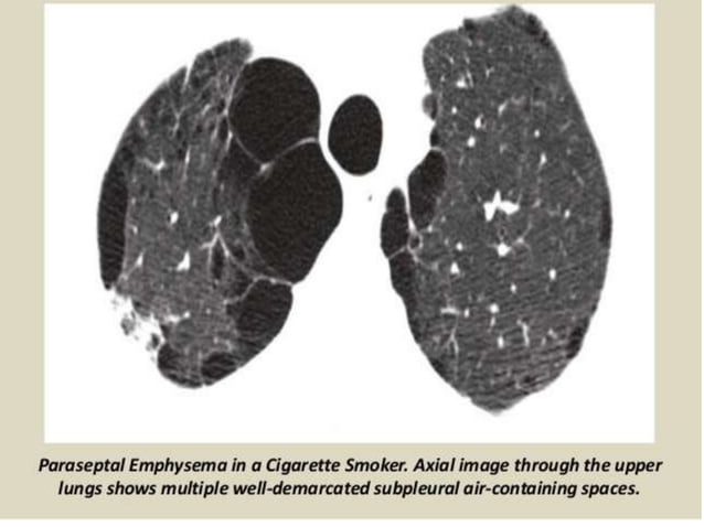 Radiological imaging of copd | PPTX | Lung and Respiratory Health ...