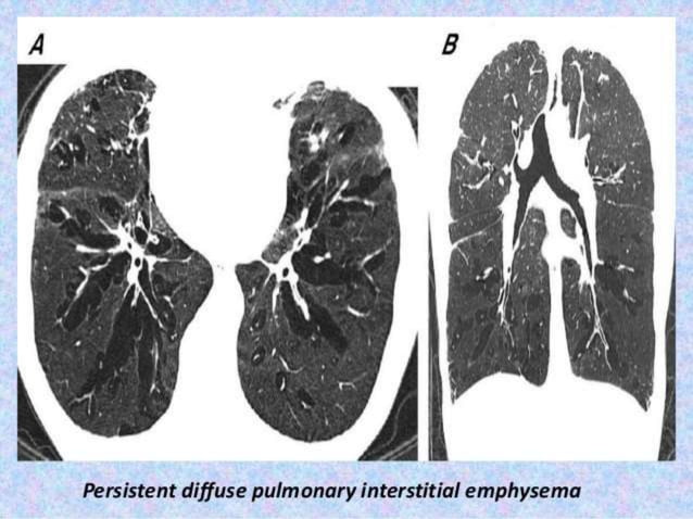 Radiological imaging of copd | PPTX | Lung and Respiratory Health ...