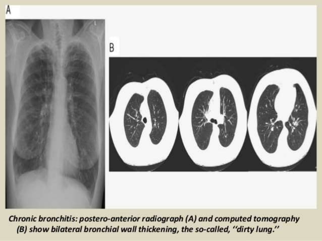 Radiological imaging of copd | PPTX | Lung and Respiratory Health ...