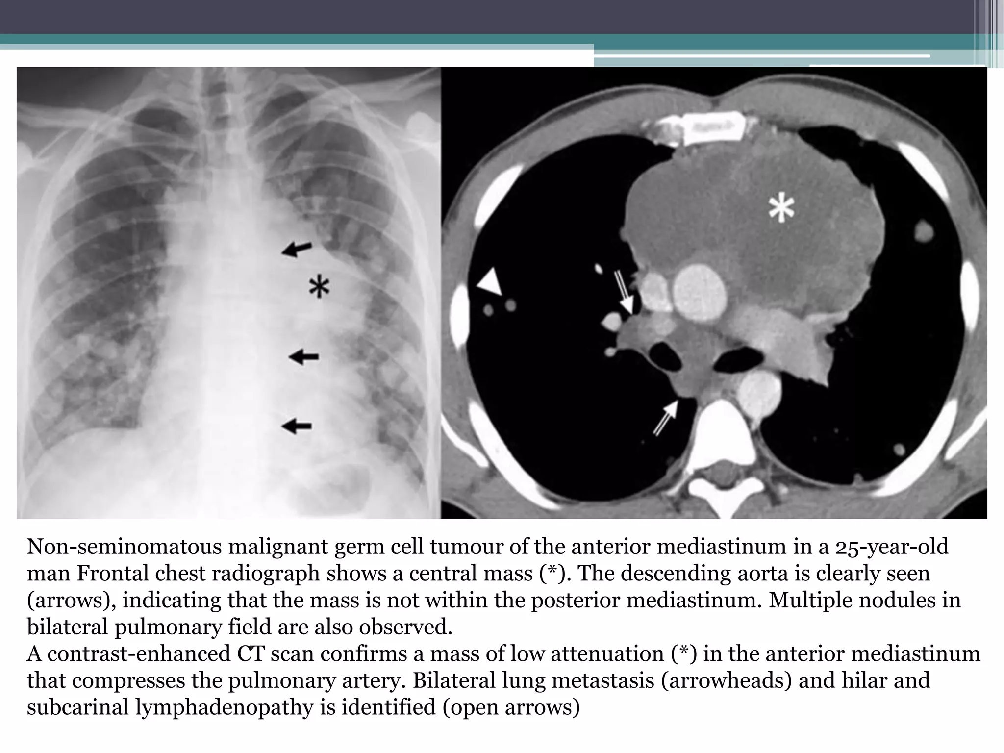 Radiological imaging of mediastinal masses | PPTX