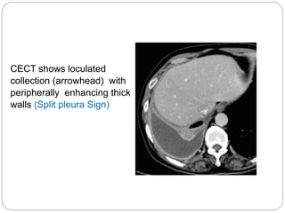 radiologicalimagingofpleuraldiseases2-170304105616.pptx