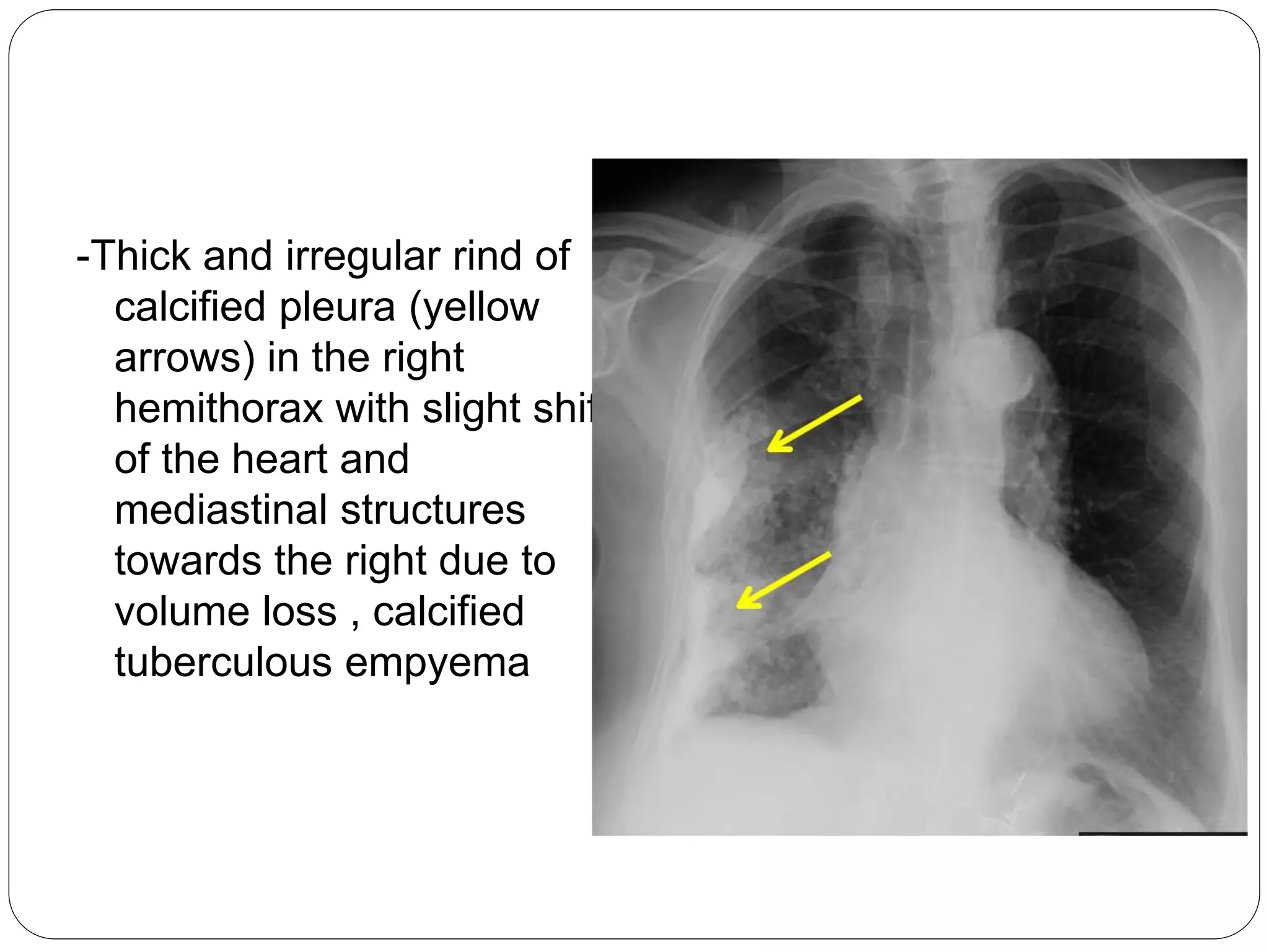 Radiological imaging of pleural diseases | PPTX