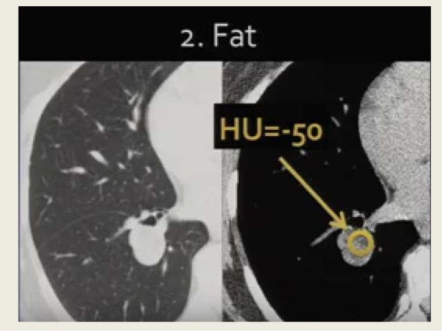 Radiological Imaging Of Single Solitary Pulmonary Nodule