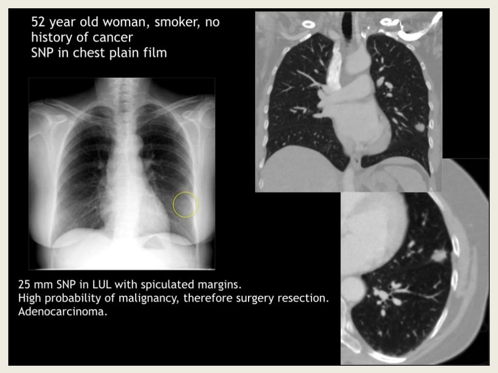 Radiological imaging of single solitary pulmonary nodule.