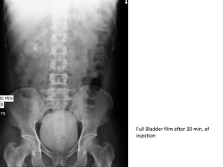 Radiological importance of intravenous pyelography | PPTX