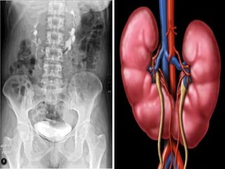 Pyelogram Vs Nephrogram Radiological importance of intravenous pyelography | PPTX