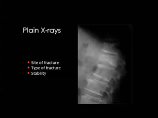 Sharp Force Trauma Radiograph Radiological Investigations of spinal Trauma.pptx