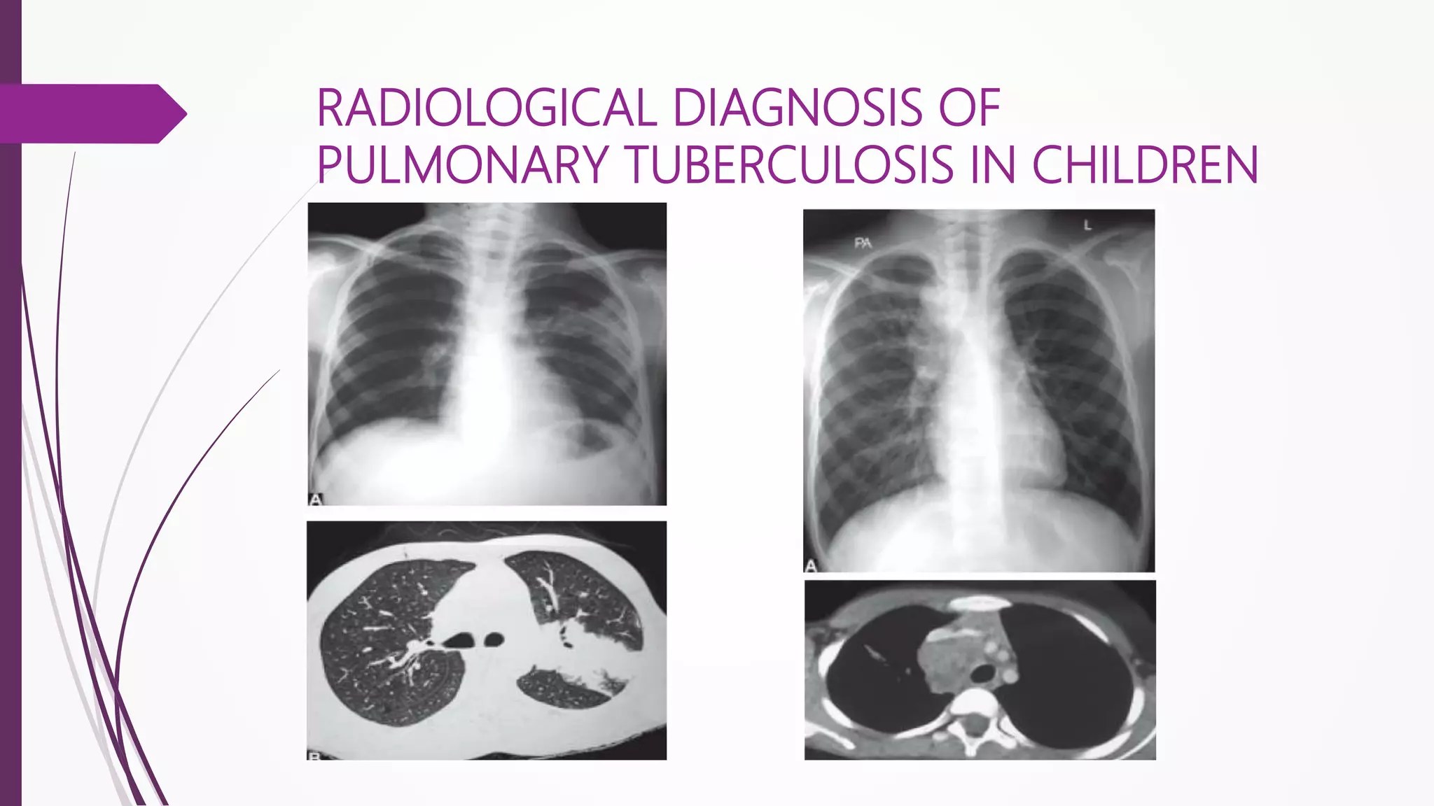 Radiological patterns, management of pediatric tb | PPT
