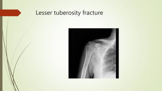 Radiological presentation fractures.pptx