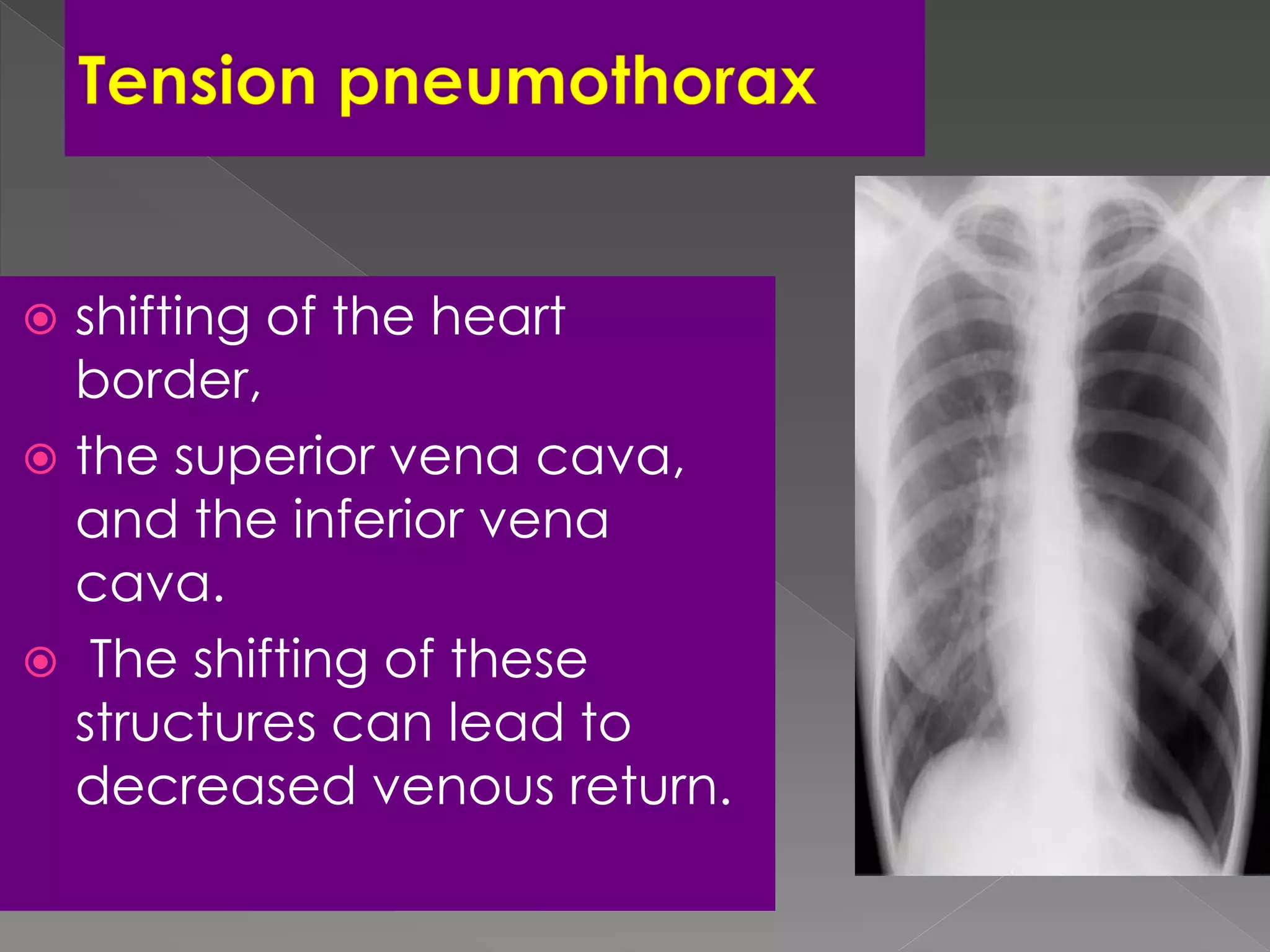  shifting of the heart
border,
 the superior vena cava,
and the inferior vena
cava.
 The shifting of these
structures can lead to
decreased venous return.
 
