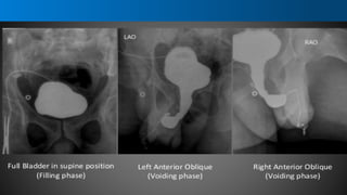 Radiological Procedure of Retrograde Urethrography.pptx